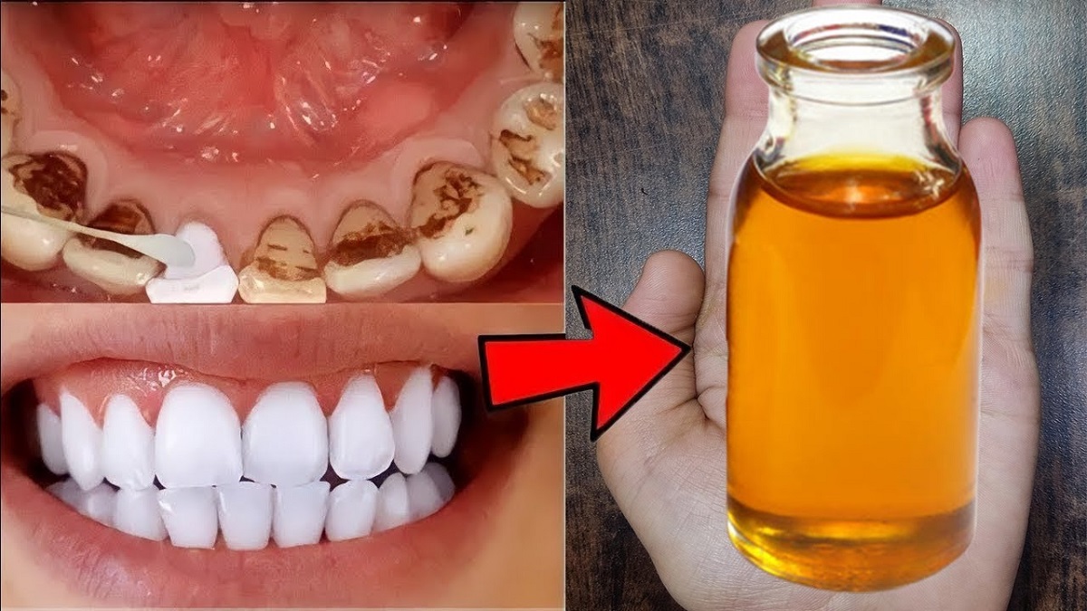 Begini Cara Ampuh Memutihkan Gigi Kuning dan Berkarang dengan Cuka Apel, 5 Langkah Bikin Gigi Putih Lagi