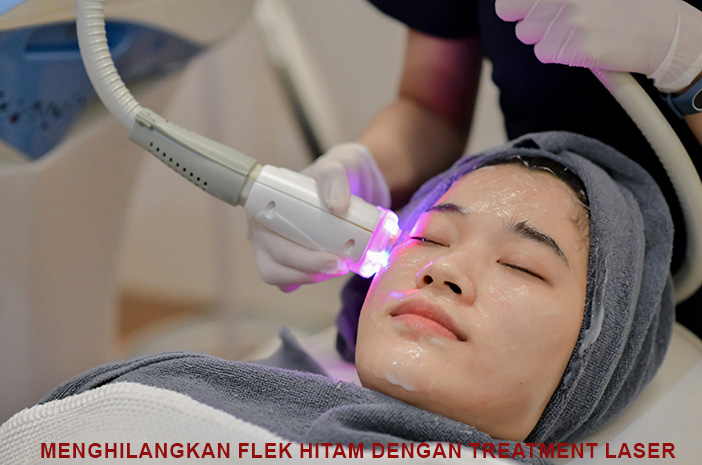 Benarkah Efektif? Cara Ampuh Menghilangkan Flek Hitam dengan Treatment Laser, Berikut Harga Terbaiknya