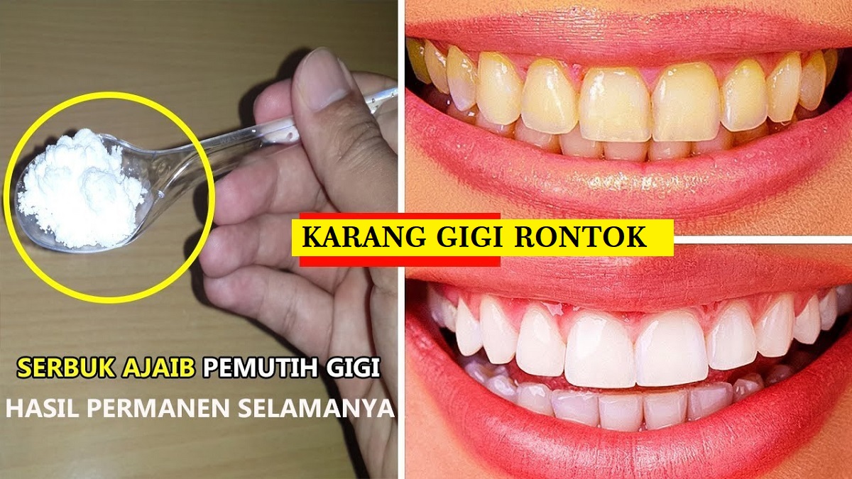 3 Cara Simpel Menghilangkan Karang Gigi yang Sudah Mengeras dengan Garam, Ampuh Bikin Gigi Putih Gak Berkarang