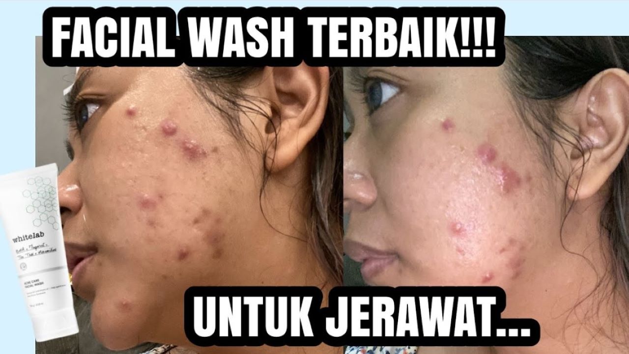 4 Facial Wash untuk Kulit Berjerawat Terbaik 2025, Bikin Wajah Mulus 