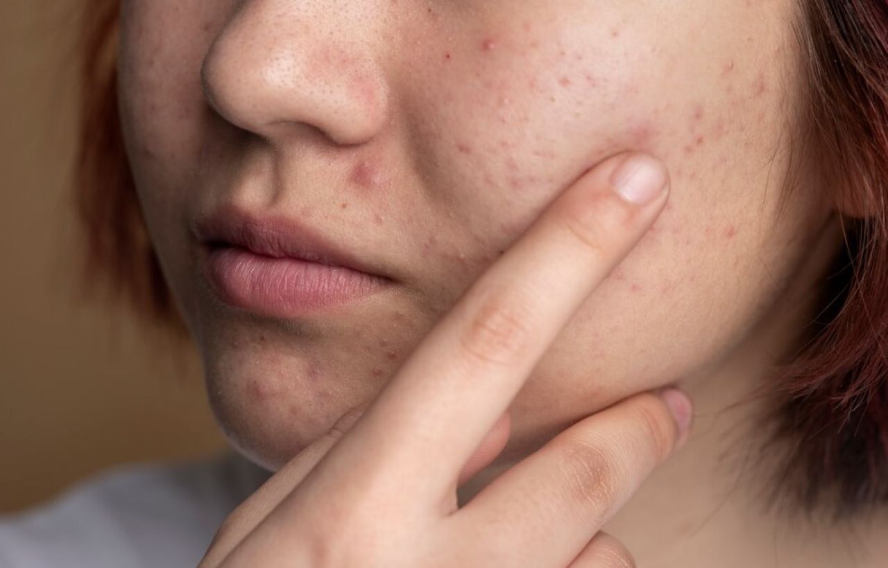 DIY Masker yang Merapatkan Pori-Pori Besar, Rahasia Kulit Mulus Bebas Komedo