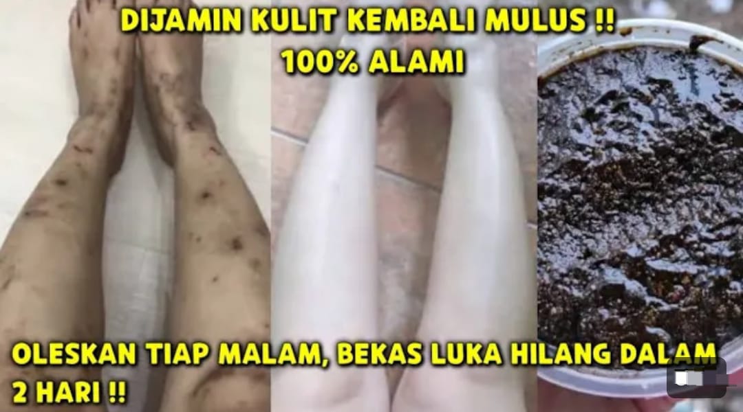 3 Cara Membuat Lulur Alami untuk Menghilangkan Bekas Koreng Dalam Semalam, Ampuh Memutihkan Kulit Permanen