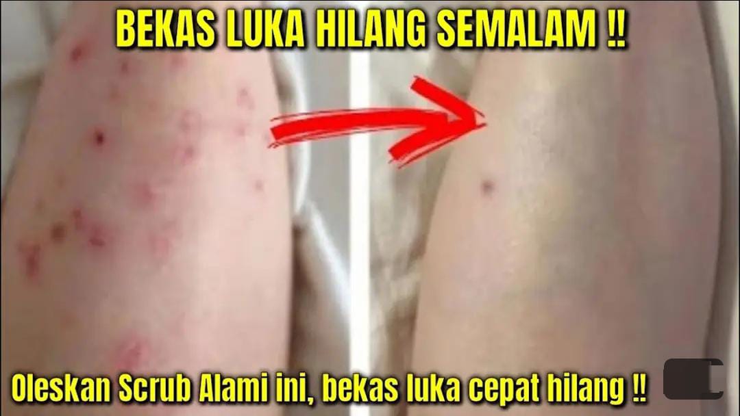 3 Cara Meracik Penghilang Bekas Koreng Hitam yang Sudah Lama, Cuma Pakai Bahan Dapur Kulit Mulus dan Putih