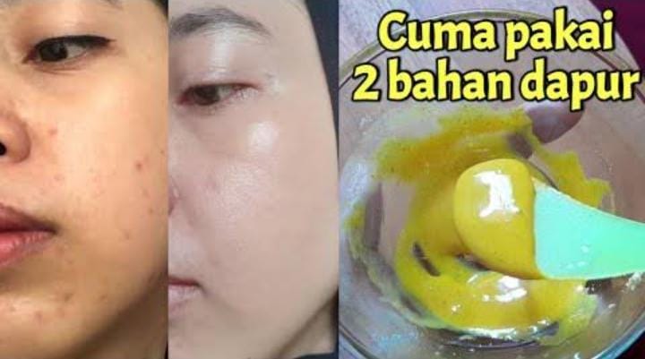 Begini 5 Cara Menghilangkan Flek Hitam dengan Masker Kunyit dalam 1 Malam, Tips Glowing Awet Muda Secara Alami