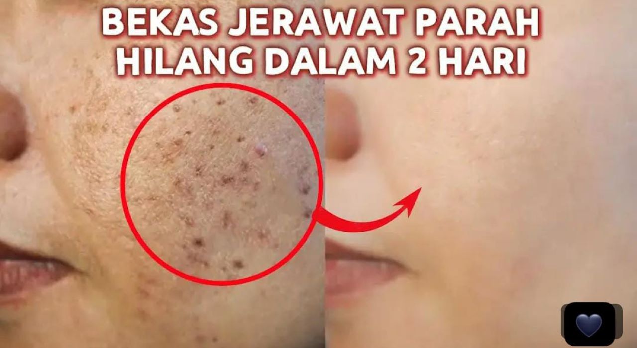 Masker Penghilang Bekas Jerawat Hitam di Wajah, Begini 3 Langkah Membuatnya Cuma Pakai Bahan Alami