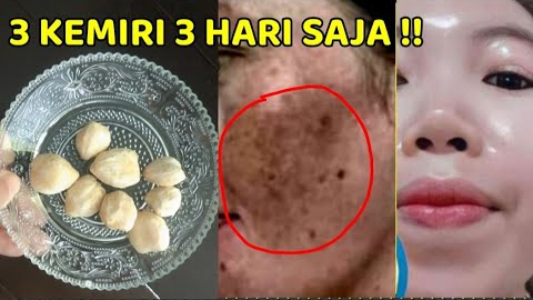 2 Cara Pakai Bahan Dapur untuk Menghilangkan Flek Hitam Menahun, Tips Kulit Mulus Tanpa Noda dan Kerutan