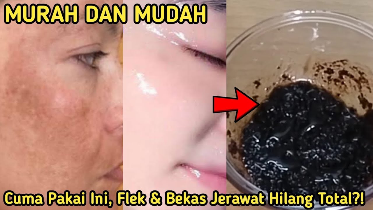 3 Cara Menghilangkan Flek Hitam Menahun dengan Bahan Alami