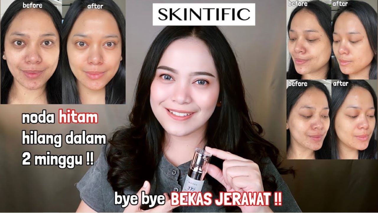 Cara Mengatasi Flek Hitam dengan Mudah, Cukup Gunakan 4 Skincare Ini Saja