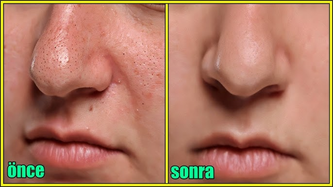 4 Cream untuk Mengecilkan Pori-Pori Wajah Agar Terlihat Halus