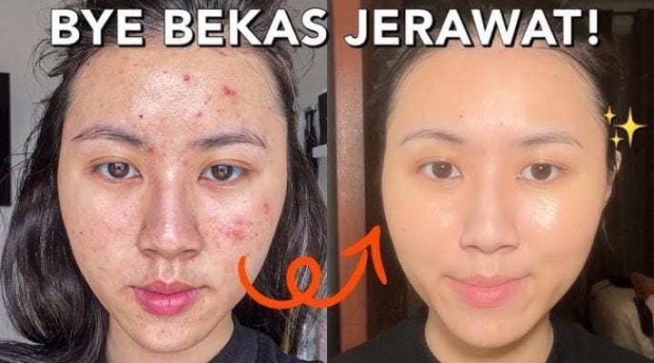 Ternyata, Begini Cara Cepat Menghilangkan Flek Hitam dengan Masker Minyak Zaitun, 4 Langkah Bikin Glowing