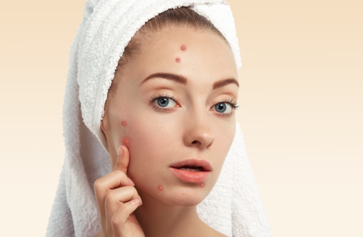 4  Rekomendasi Acne Patch dibawah 50 ribu yang Bagus untuk Jerawat