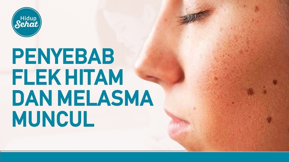 Wajib Waspada! 5 Kosmetik yang Menyebabkan Flek Hitam di Wajah Makin Menebal, Hentikan Sebelum Wajah Rusak!