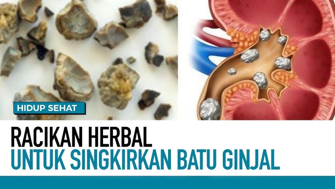 7 Minuman Yang Bisa Menghancurkan Batu Ginjal Secara Alami, Simak Salah Satunya Air Putih