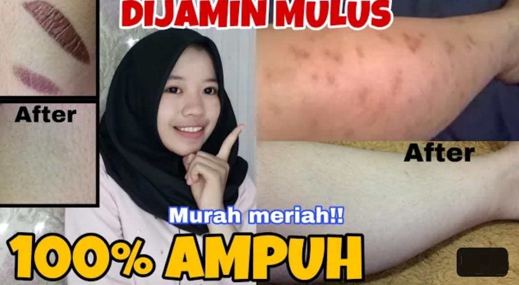 4 Cara Menghilangkan Koreng di Kaki Dengan Cepat Menggunakan Bahan Alami, Bekas Luka Hitam jadi Putih Permanen