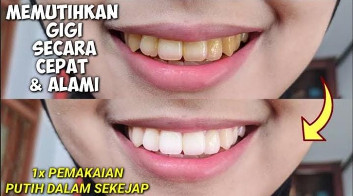 Cara Memutihkan Gigi Berkerak dalam 1 Malam, Cuma Pakai 1 Jenis Buah Gigi Kuning Jadi Putih Permanen