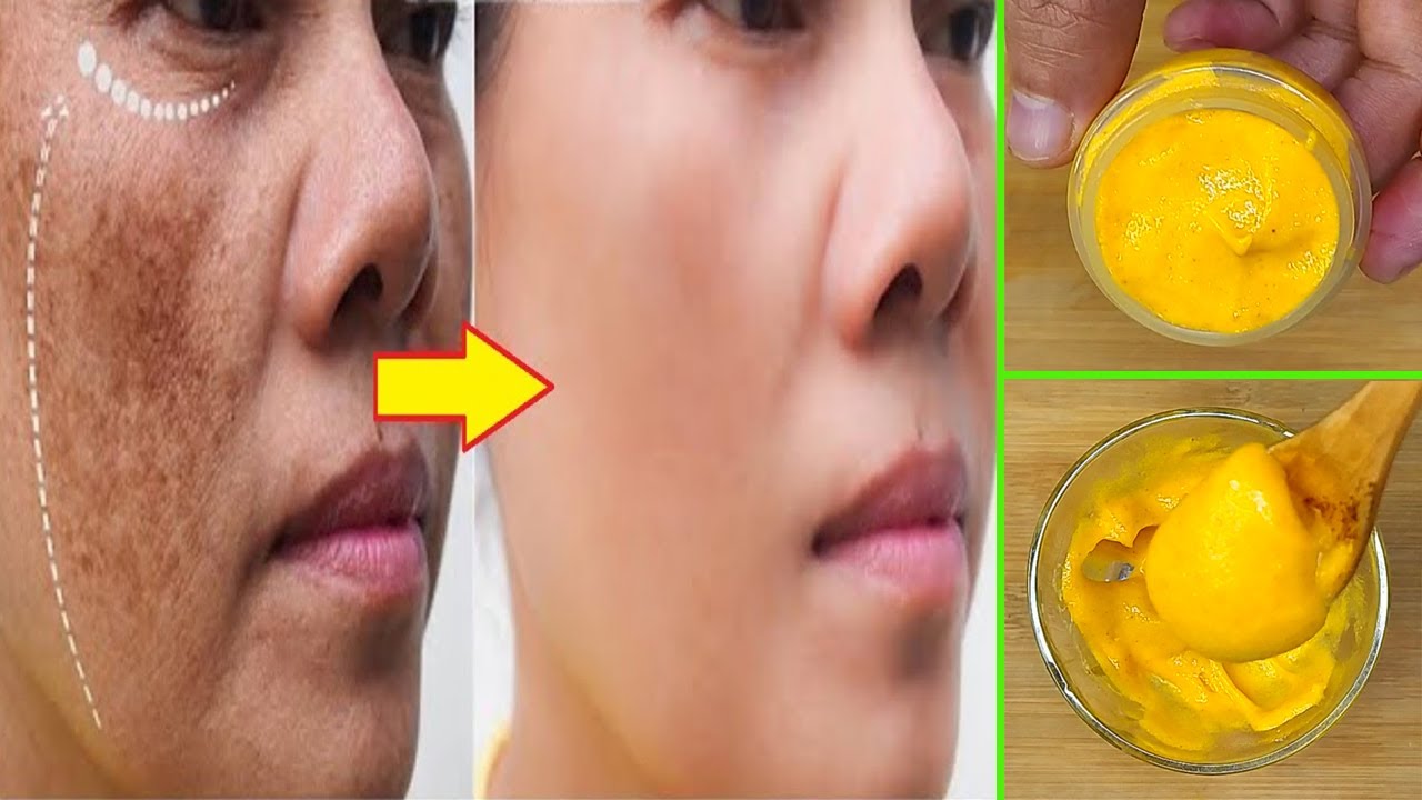 3 Cara Cepat Menghilangkan Flek Hitam dengan Kunyit dalam 1 Hari, Bikin Kulit Glowing Alami Tanpa Skincare