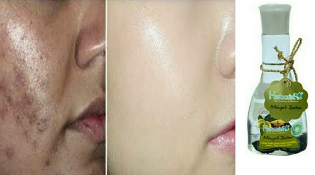 Cara Cepat Atasi Flek Hitam dengan Minyak Zaitun, 2 Tips Wajah Cerah dan Glowing Bebas Noda