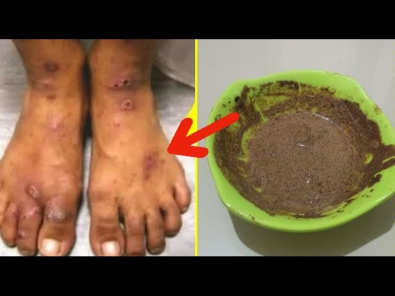 3 Cara Ampuh Menghilangkan Bekas Koreng Hitam Secara Alami yang Aman dan Bebas Iritasi