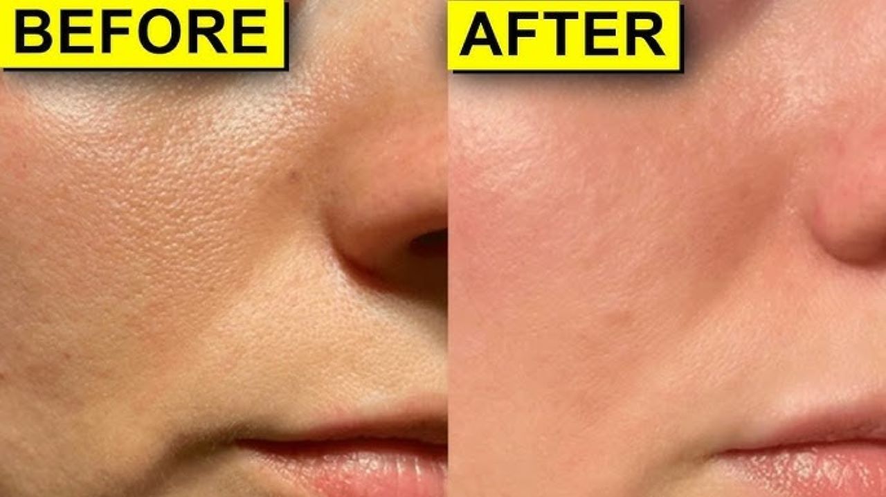 5 Bahan Alami Pengecil Pori-Pori yang Mudah Dipakai, Bikin Wajah Mulus Tanpa Komedo