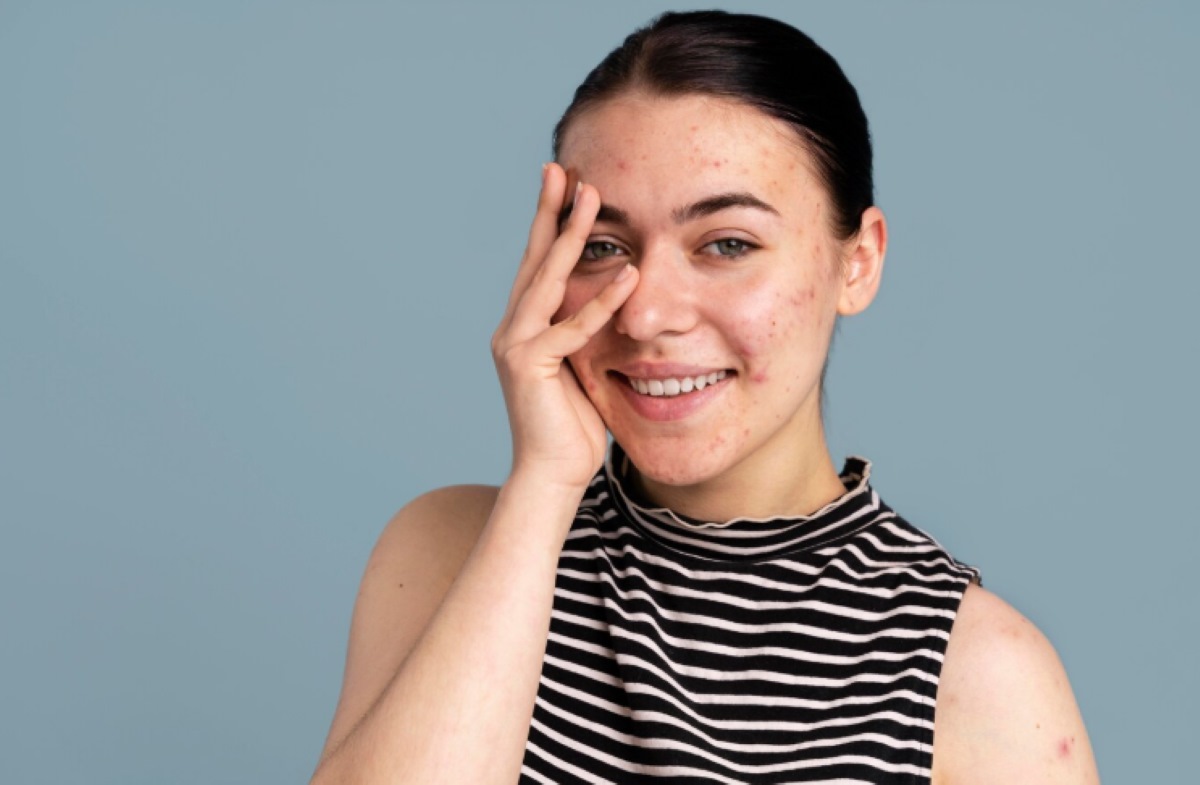 Rekomendasi Produk Untuk Kulit Berjerawat Dijamin Nampol dan Bebas dari Jerawat 