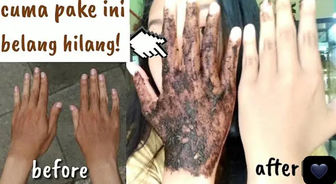 3 Cara Menghilangkan Kulit Belang di Tangan Dalam 1 Minggu! Jadi Cerah Merata