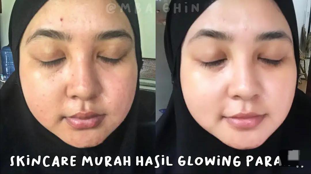 Inilah Rahasia Wajah Putih Glowing Dalam 1 Malam, Cuma Pakai 1 Bahan Wajah Langsung Mulus Bebas Flek Hitam