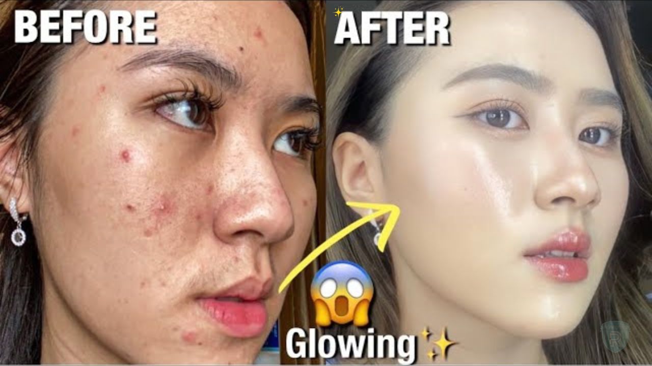 4 Rekomendasi Tinted Sunscreen untuk Kulit Berjerawat, Bikin Wajah Glowing Terlindungi Seharian