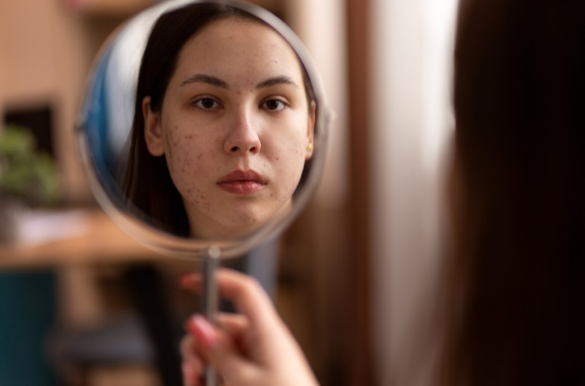 Tips and Trick Menutupi Bekas Jerawat Kehitaman atau Jerawat Kemerahan