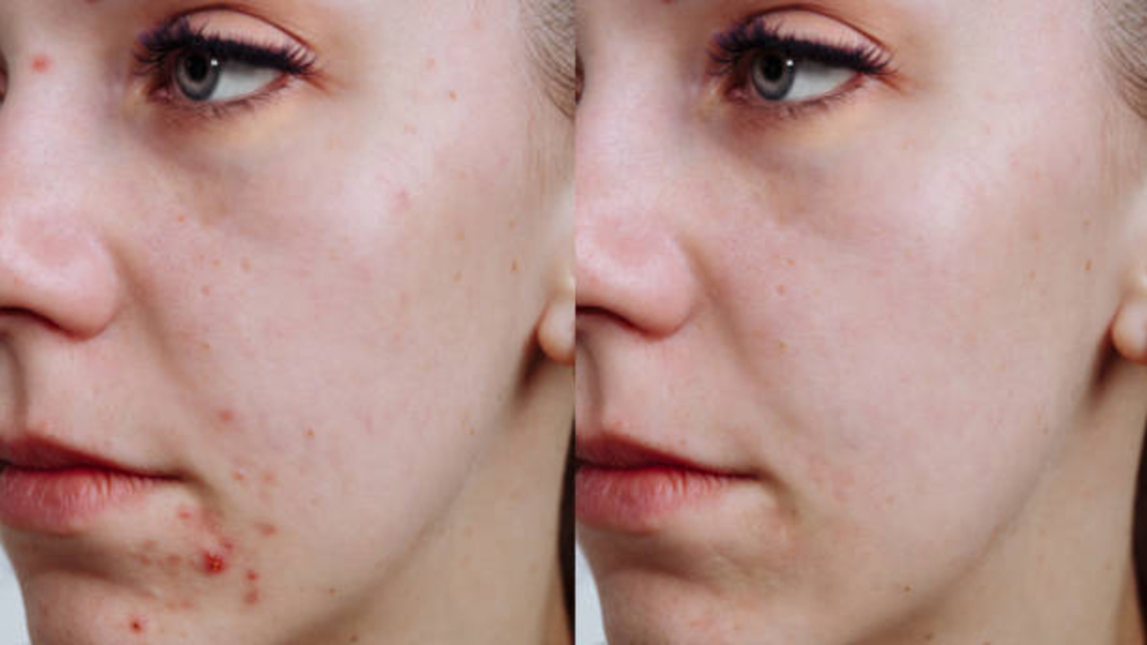 Wajah Breakout? Coba Rekomendasi Skincare untuk Kulit Berjerawat yang Aman dan Cocok untuk Pemula