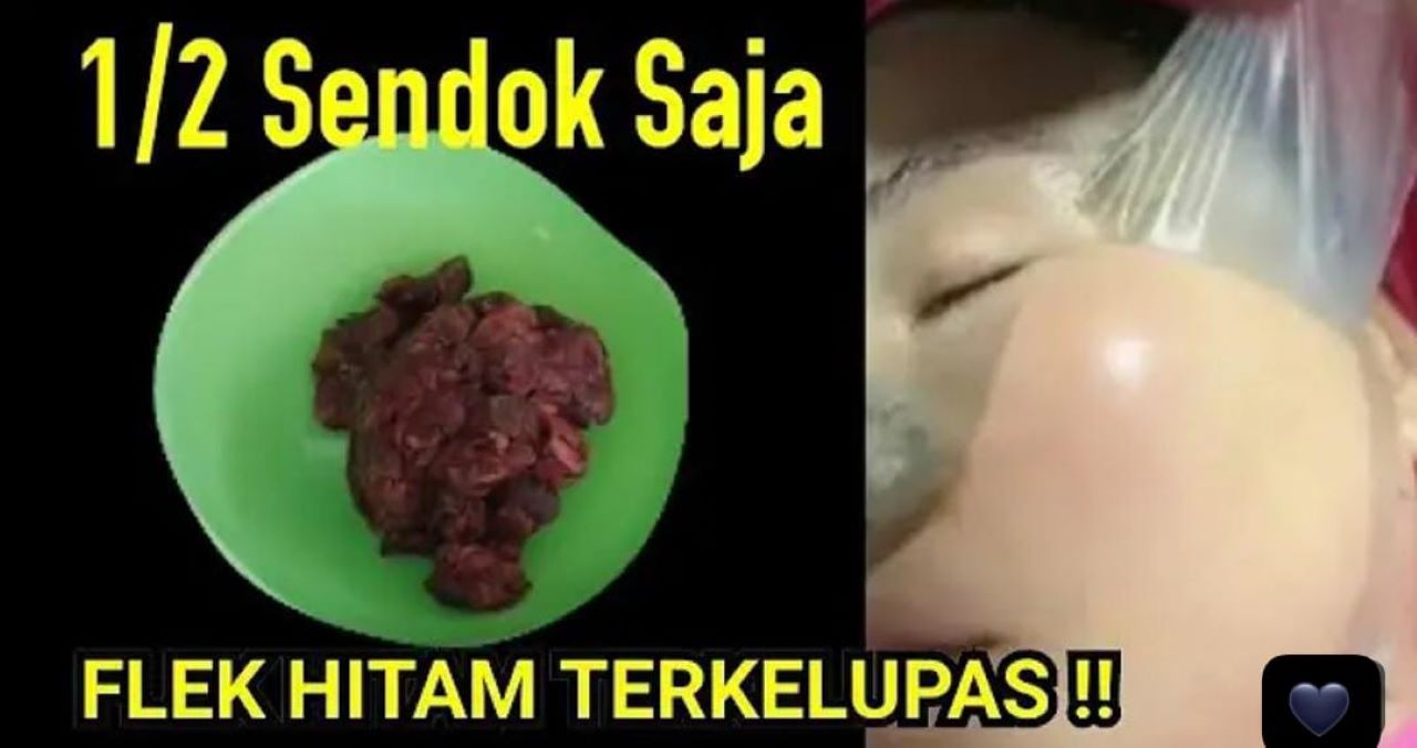 2 Tips Mengelupas Flek Hitam Dalam 1 Malam Pakai Bumbu Dapur, Kulit jadi Glowing!