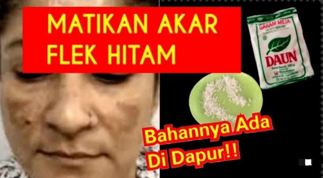 4 Cara Menghilangkan Flek Hitam Tebal Di Wajah Secara Alami Kulit