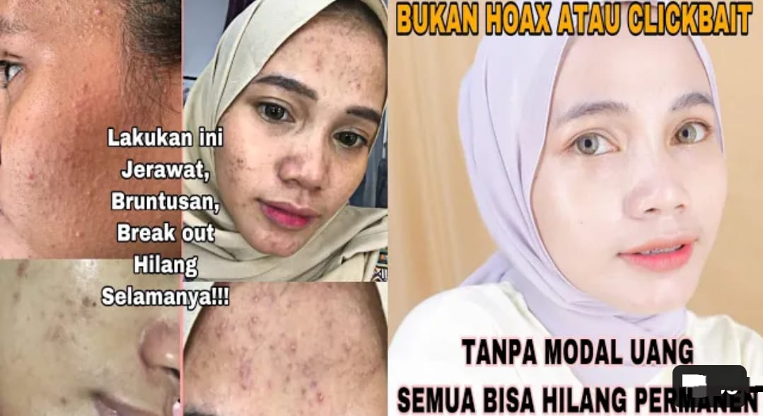 4 Cara Menghilangkan Noda Hitam Bekas Jerawat yang Membandel Secara Alami, Kulit Putih Glowing Sekali Usap