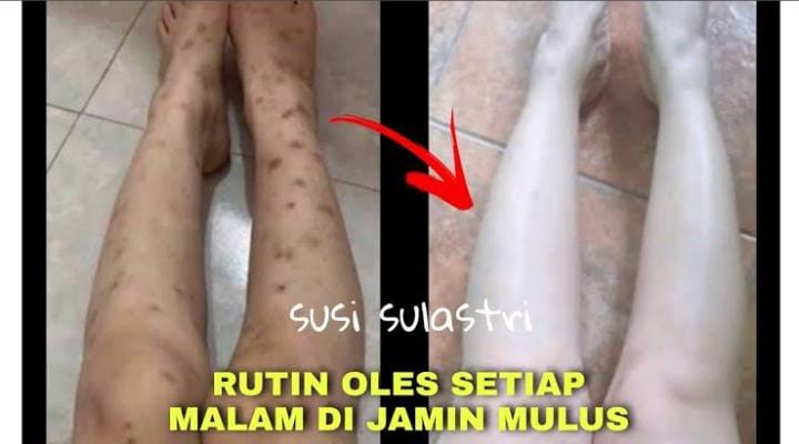 3 Racikan Bahan Alami Paling Ampuh Menghilangkan Bekas Koreng yang Menghitam, Bikin Kulit Kenyal Bebas Noda