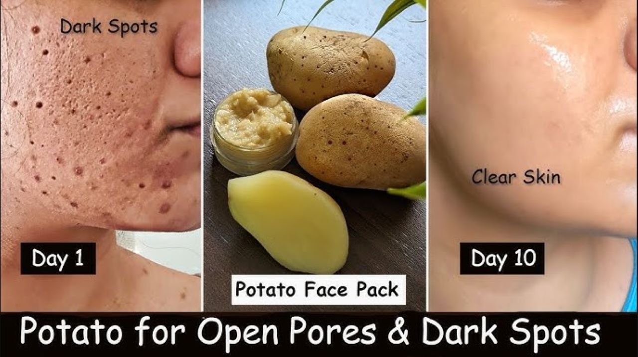 DIY Masker Kentang Pengelupas Flek Hitam dalam 1 Malam, Begini Cara Meraciknya 