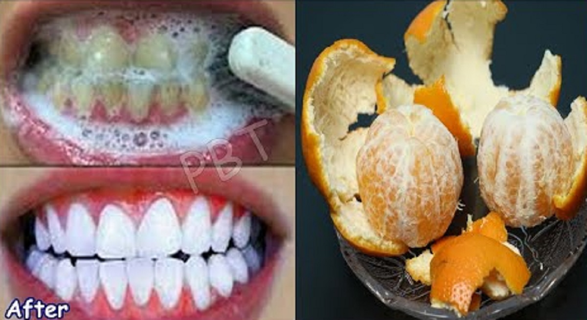 Cara Mudah Menghilangkan Karang Gigi yang Sudah Menebal dan Mengeras dengan Kulit Jeruk, Efektif dalam 1 Hari