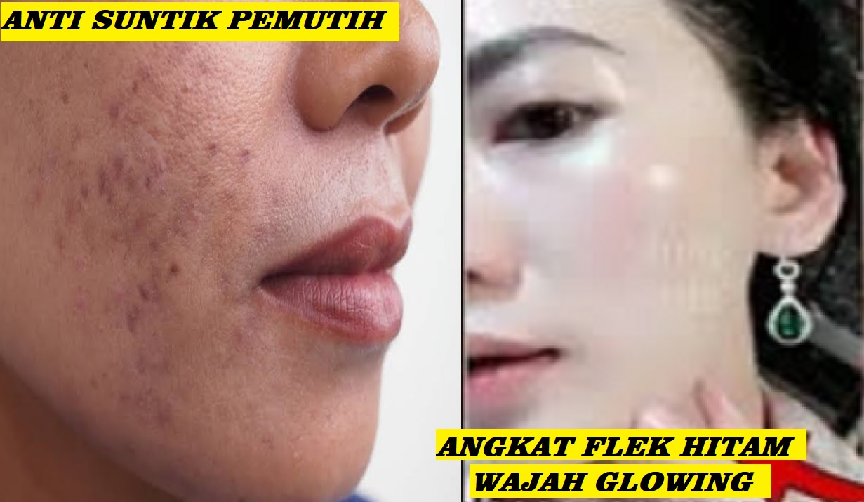 3 Cara Alami Menghilangkan Flek Hitam di Pipi Paling Cepat dan Ampuh, Efektif Wajah Glowing Angkat Noda Hitam