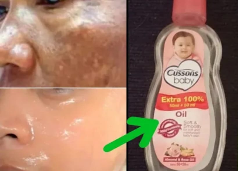 Cara Menghilangkan Flek Hitam dengan Baby Oil Dalam 1 Hari, Bantu Memutihkan Wajah dan Kecilkan pori-Pori