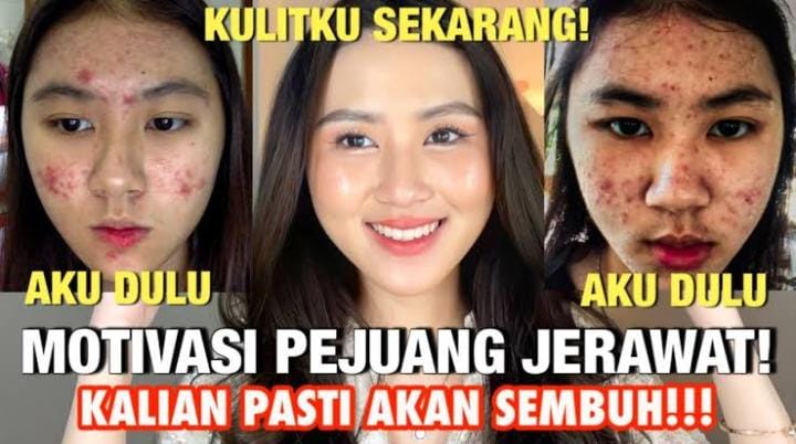 Ternyata, Ini 4 Masker Alami yang Ampuh Basmi Jerawat Membandel dengan Cepat, Bikin Kulit Putih Bebas Noda