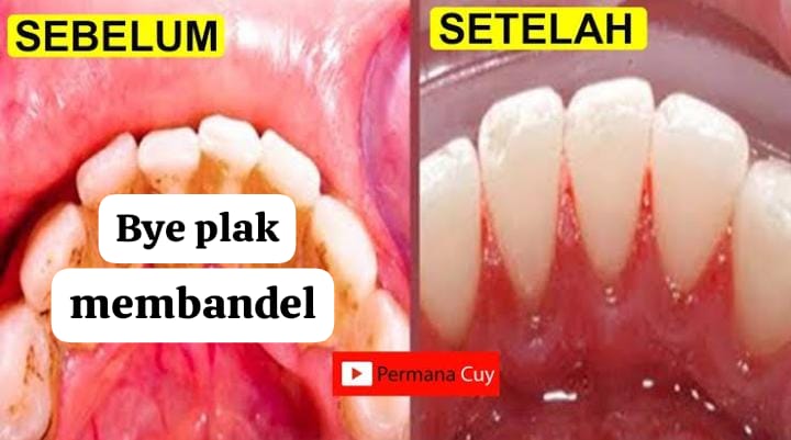 5 Pasta Gigi Perontok Karang Gigi Terbaik, Ampuh Memutihkan Bikin Bersih Tanpa Plak dalam Waktu Singkat
