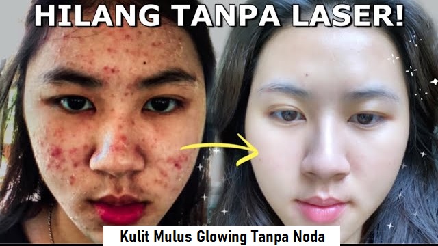 3 Serum untuk Mengecilkan Pori-Pori dan Menghilangkan Bekas Jerawat dengan Cepat, Mulus Glowing Bebas Noda!