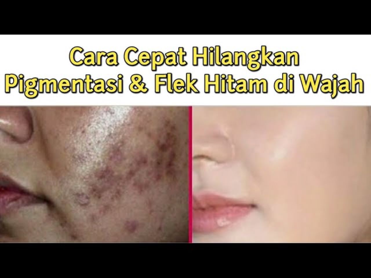 Cara Supaya Flek Hitam Hilang Permanen Dengan Mudah! Cuma Pakai 1 Jenis Buah Wajah jadi Glowing