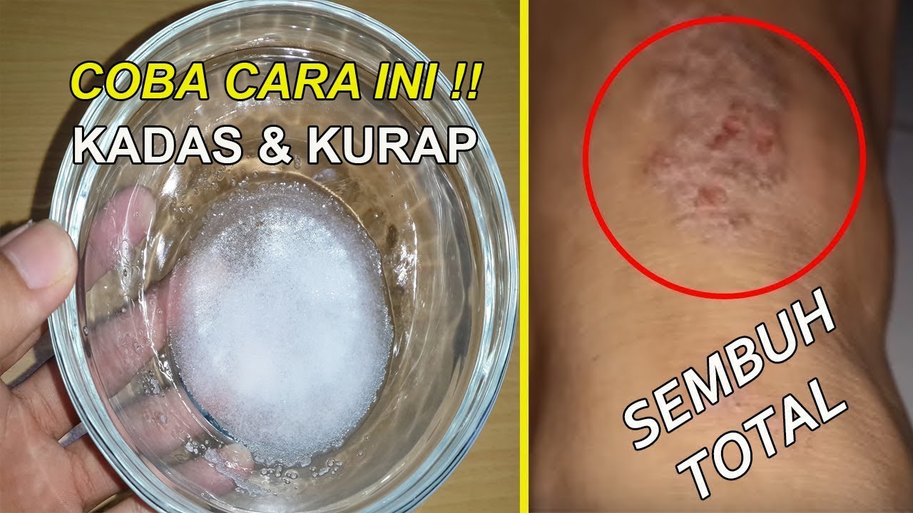 Ini Dia 5 Obat Kurap Alami yang Dapat Dikonsumsi Tanpa Biaya Mahal, Sangat Bermanfaat di Musim Hujan