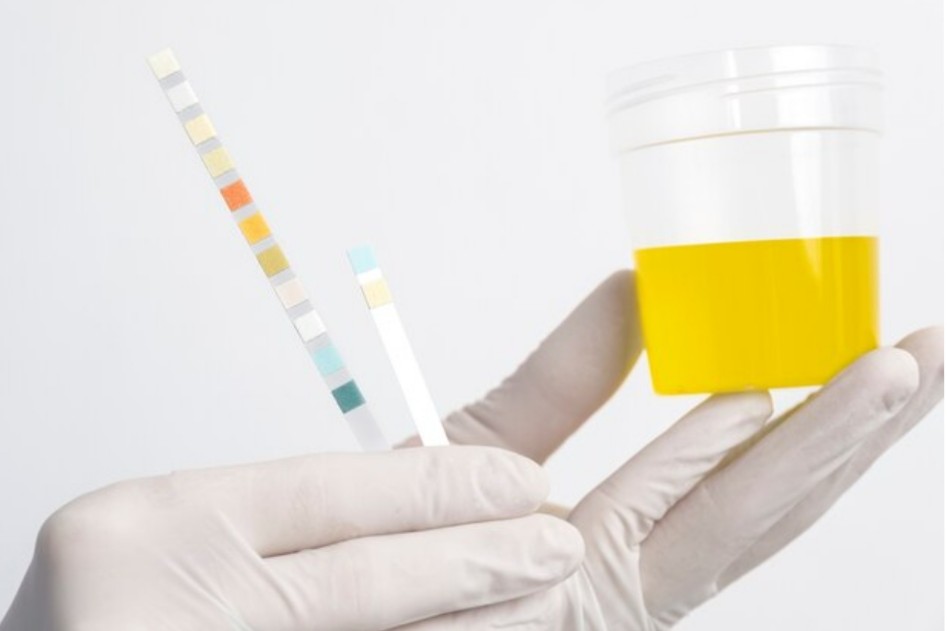 Begini 4 Cara Mengetahui Ginjal Sehat yang Bisa Dikenali dengan Warna Urine