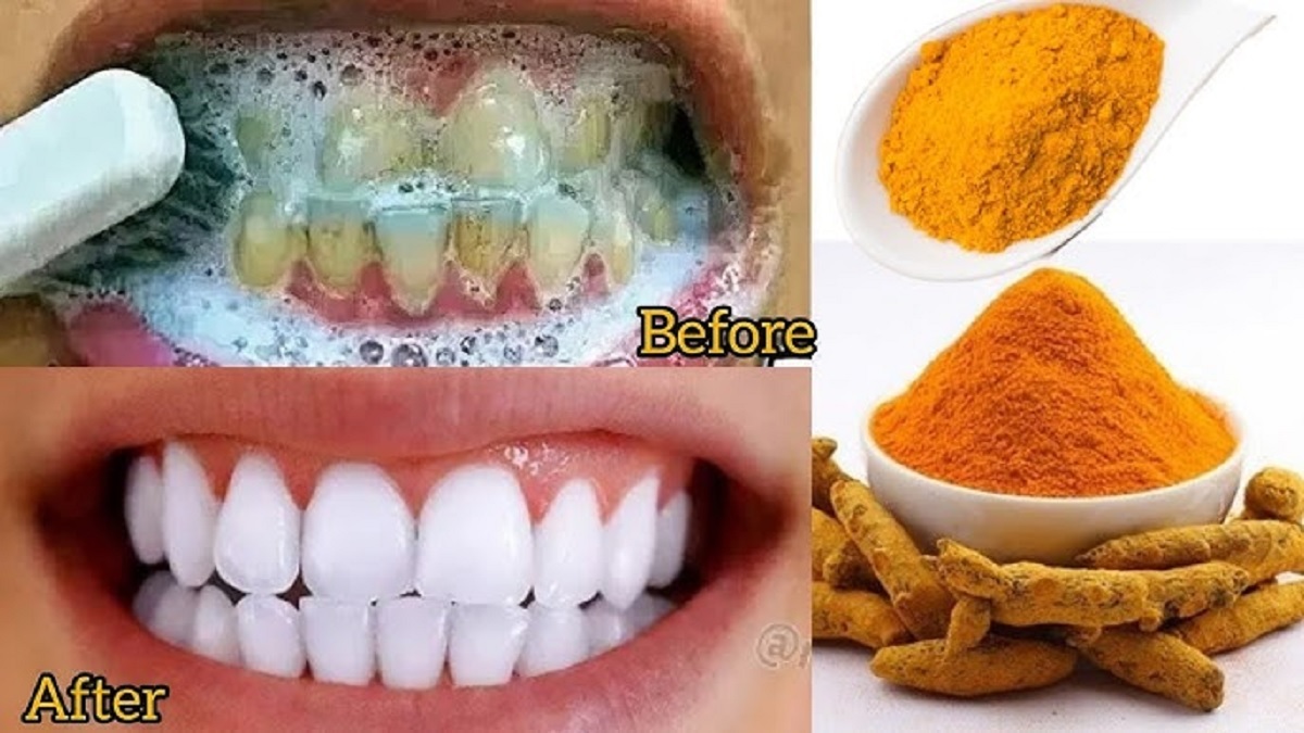 Racikan DIY Pemutih Gigi dari Bahan Dapur, Ampuh Bikin Plak dan Karang Tebal di Gigi Rontok dalam 1 Malam