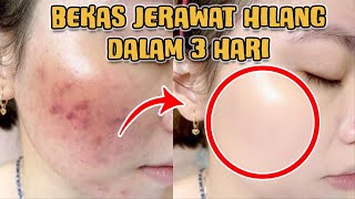 Cepat dan Efektif, Cara Menghilangkan Bekas Jerawat Secara Alami dalam Waktu 3 Hari