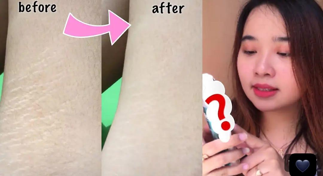 4 Cara Menghilangkan Stretch Mark Secara Alami dan Permanen