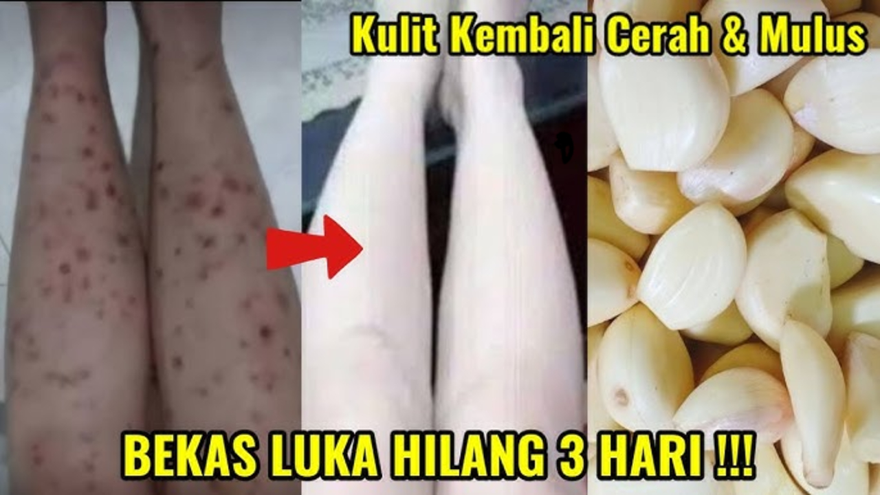 3 Cara Menghilangkan Bekas Koreng dalam 1 Hari, Bikin Kulit Mulus Lagi!