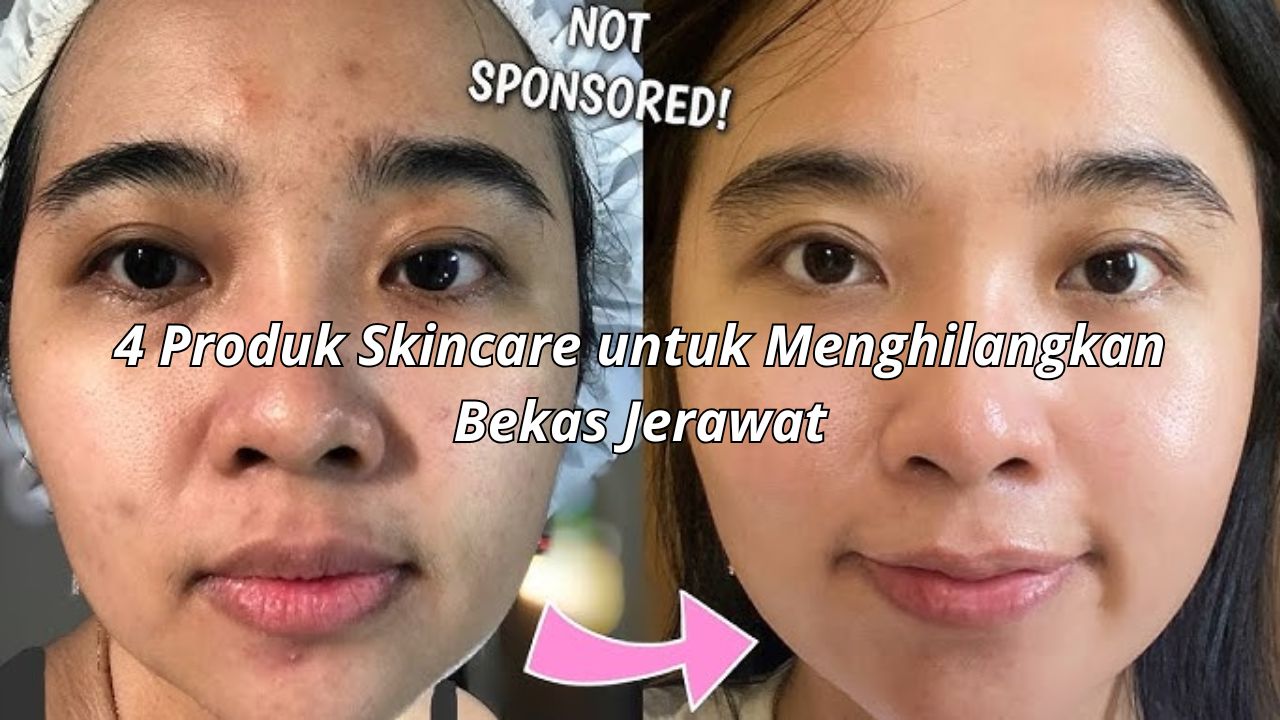 4 Produk Skincare untuk Menghilangkan Bekas Jerawat, Rahasia Kulit Cerah Merata 