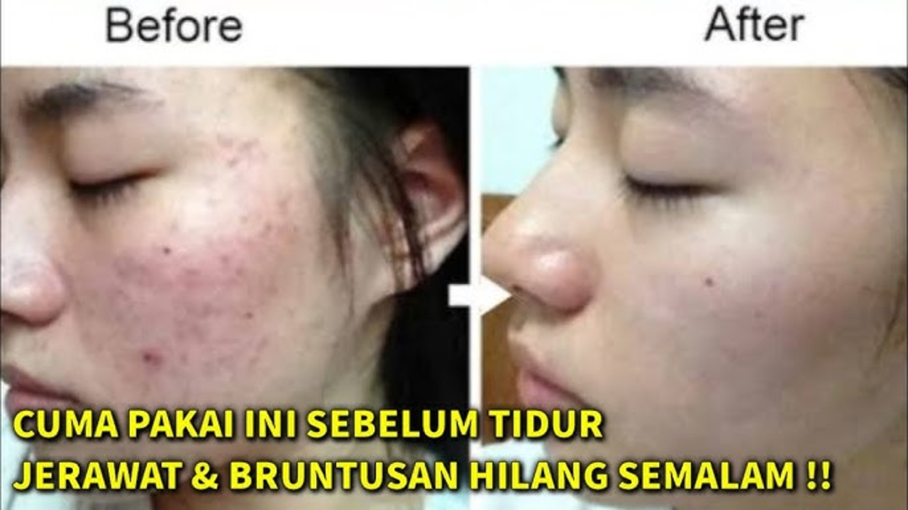 Terungkap! Inilah Cara Menghilangkan Jerawat Secara Alami dalam 1 Hari