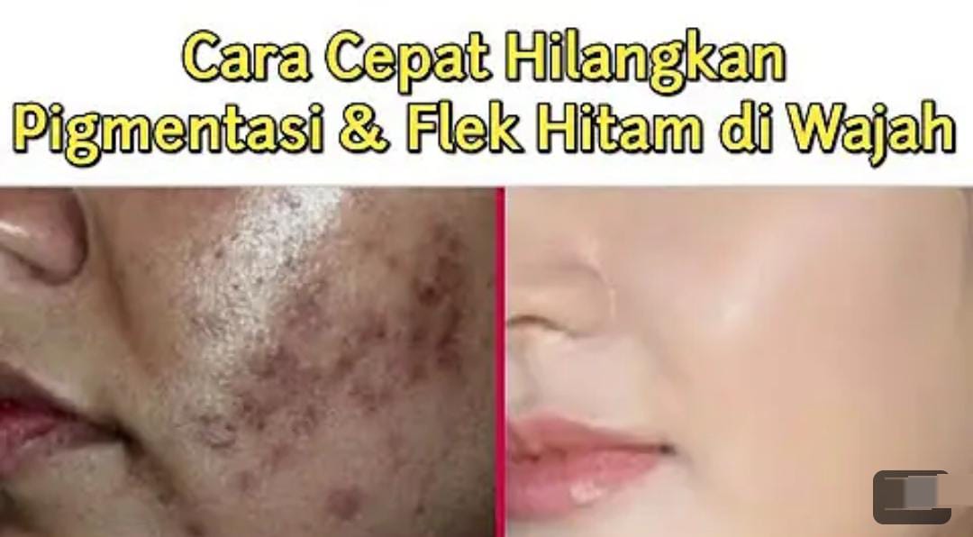 Wajah Glowing Tanpa Flek Hitam, Ini 3 Cara Menghilangkan Noda Hitam Tebal di Wajah yang Cepat Secara Alami